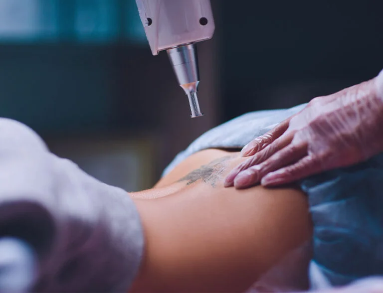 Profissional de dermatologia aplicando laser nd:yag para remoção de tatuagem pigmentada em braço de paciente.