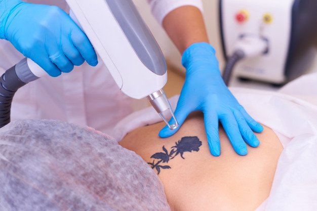 Profissional de dermatologia aplicando laser nd:yag para remoção de tatuagem pigmentada em braço de paciente.