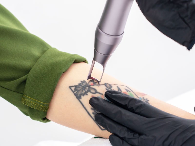 Profissional de dermatologia aplicando laser nd:yag para remoção de tatuagem pigmentada em braço de paciente.