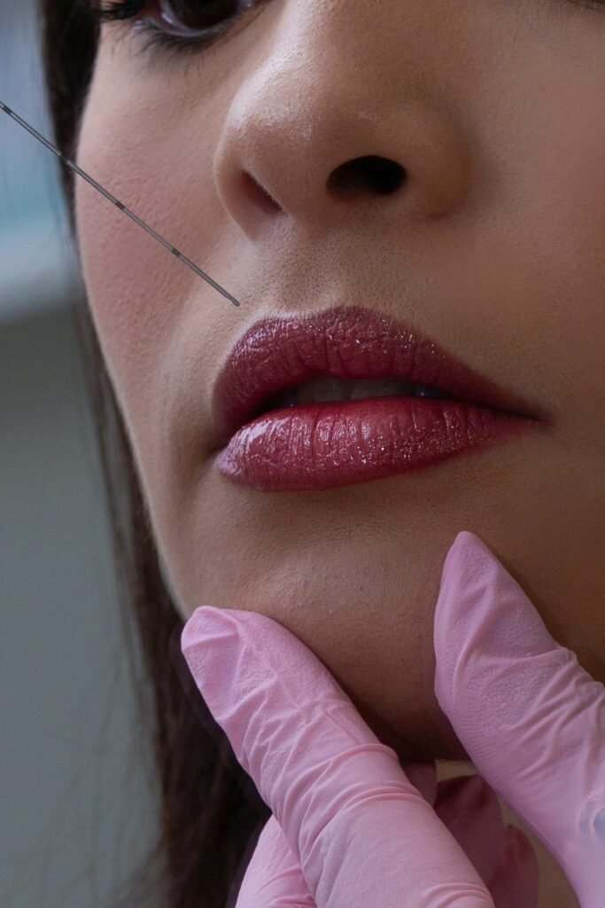 Close-up de aplicação de preenchimento labial com ácido hialurônico - preenchimento labial natural | Fanti Clinic