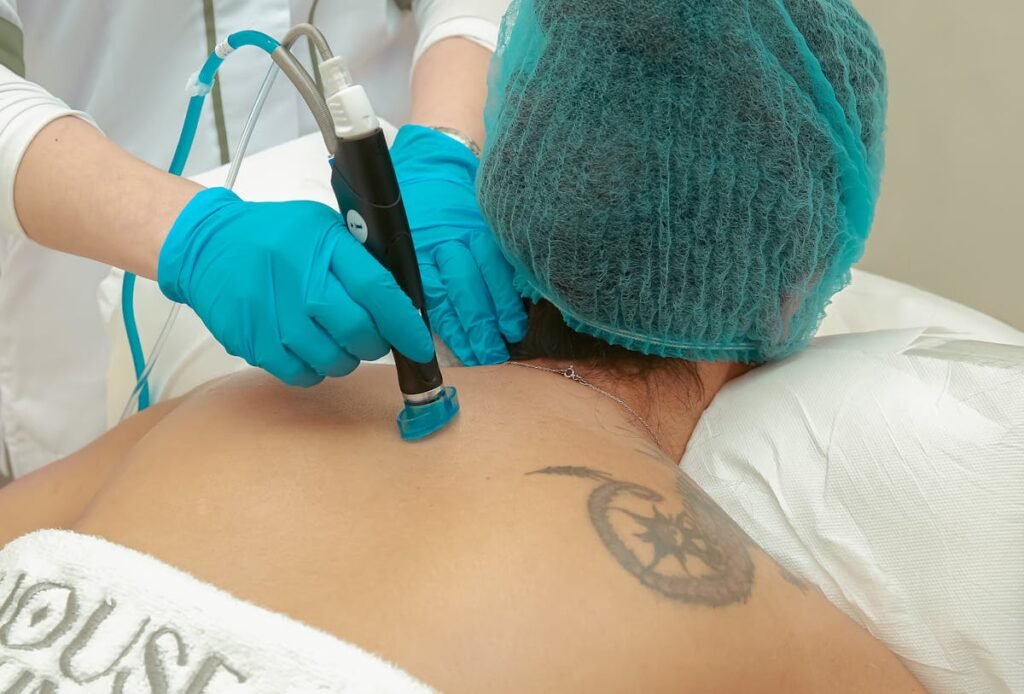 Profissional aplicando laser de remoção de tatuagem em paciente - remoção de tatuagem dói | Fanti Clinic